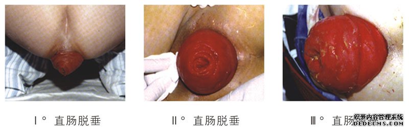 治療脫肛最好的方法是什么？