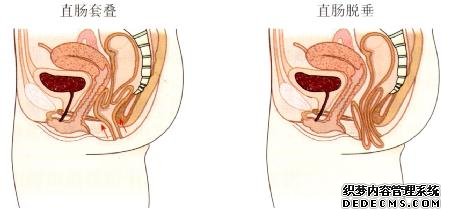 脫肛會是哪些疾病