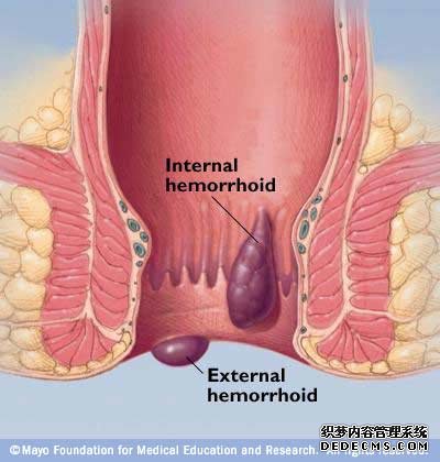 內(nèi)痔癥狀有哪些呢