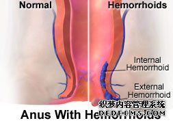 外痔早期癥狀有哪些？