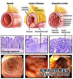 哪些原因?qū)е陆Y(jié)腸炎？