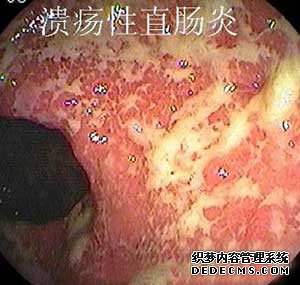 直腸炎和直腸癌的區(qū)別是什么